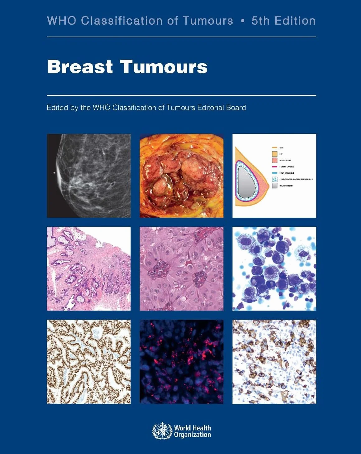Breast Tumours: Who Classification of Tumours: 2