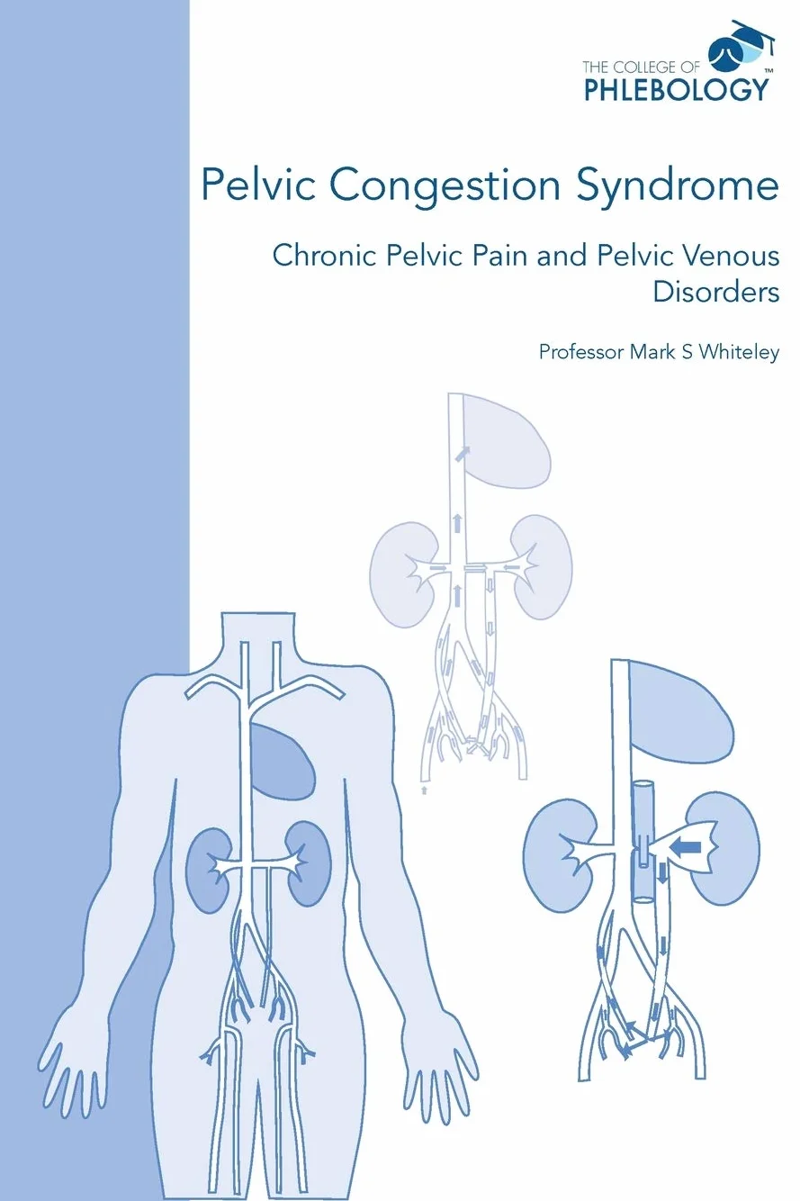 Pelvic Congestion Syndrome - Chronic Pelvic Pain and Pelvic Venous Disorders