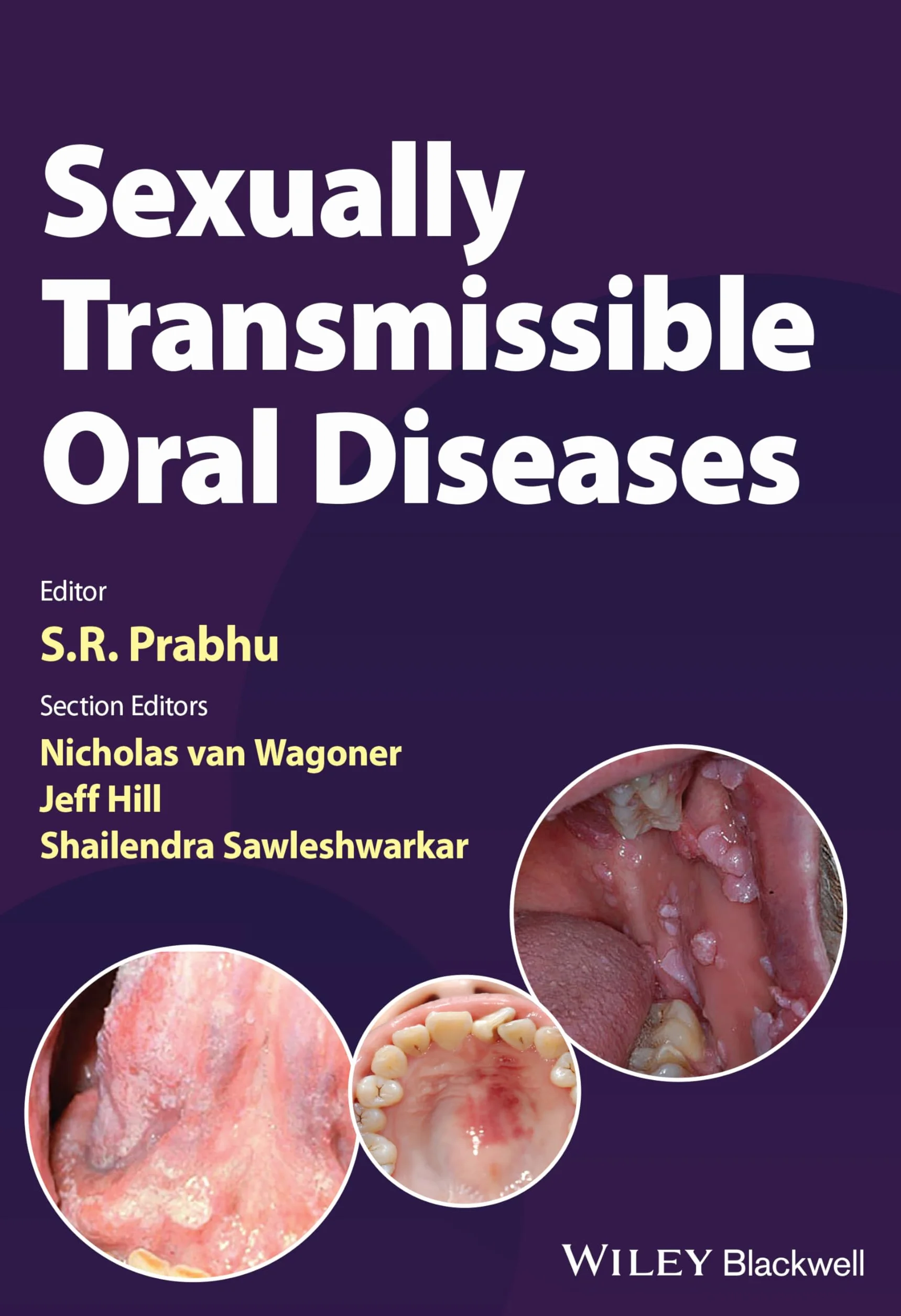 Sexually Transmissible Oral Diseases