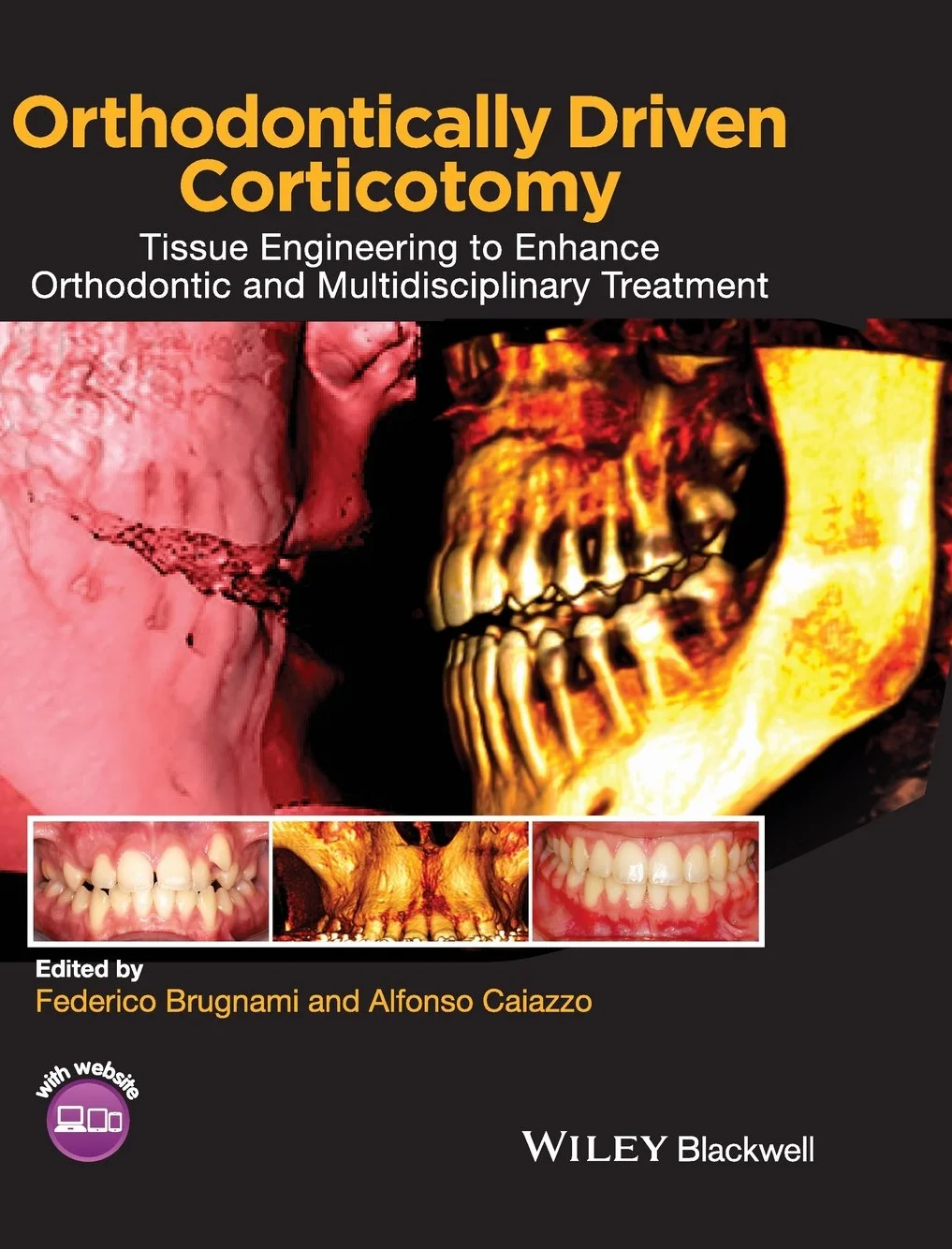 Orthodontically Driven Corticotomy: Tissue Engineering for Orthodontic and Multidisciplinary Treatment